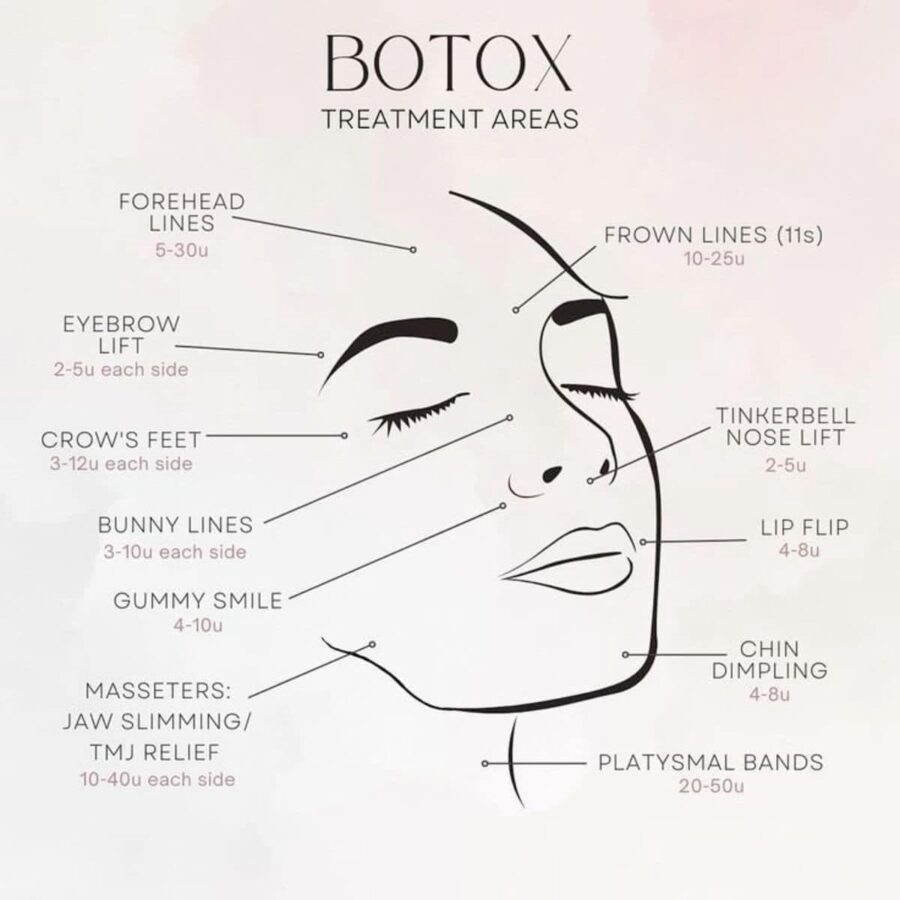 Botox treatment areas illustration 