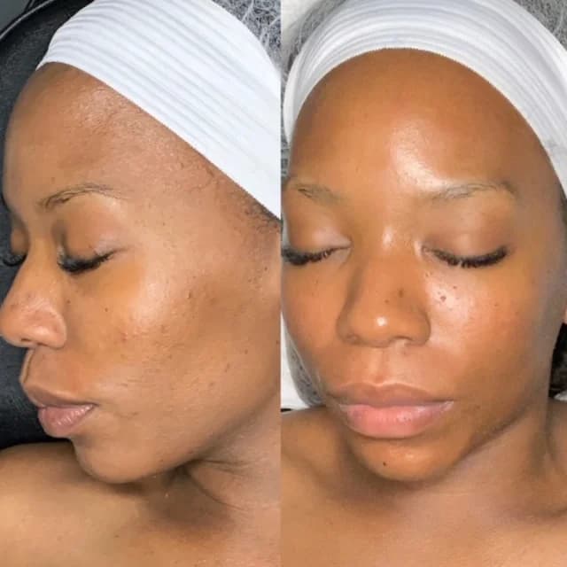 Microdermabrasion on dark skin before and after pictures