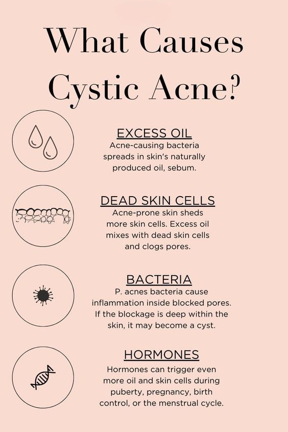 What Causes Cystic Acne