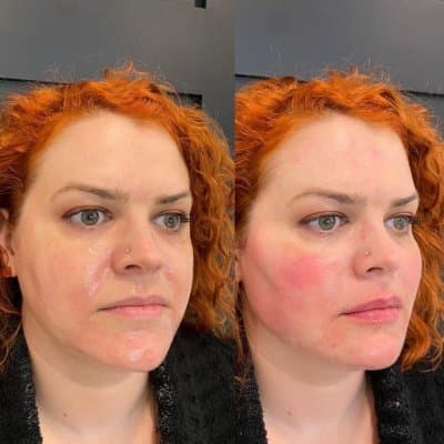Facial Balancing Before And After before and after facial balancing with fillers