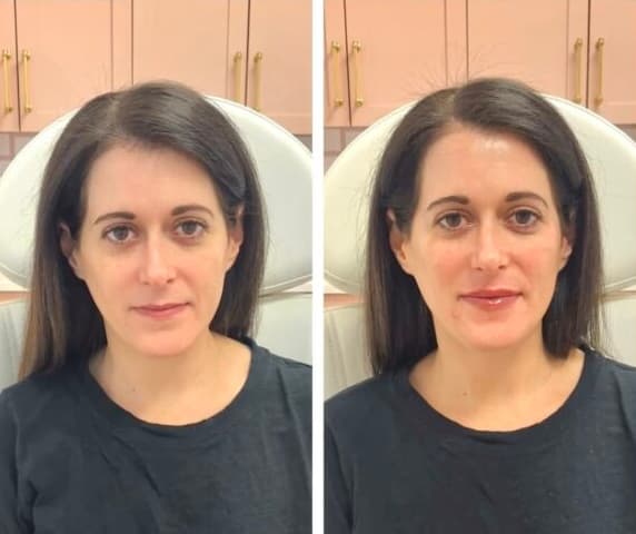 Facial Balancing Before And After facial balancing filler before after image