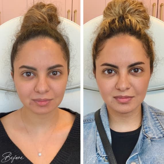 Facial Balancing Before And After facial balancing filler before after pic