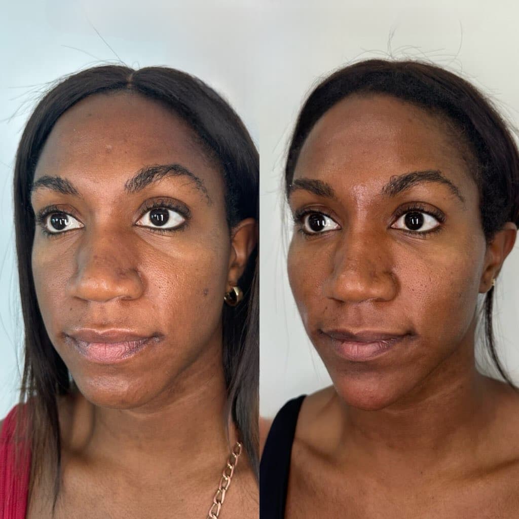 Facial Balancing Before And After facial balancing filler before after pics