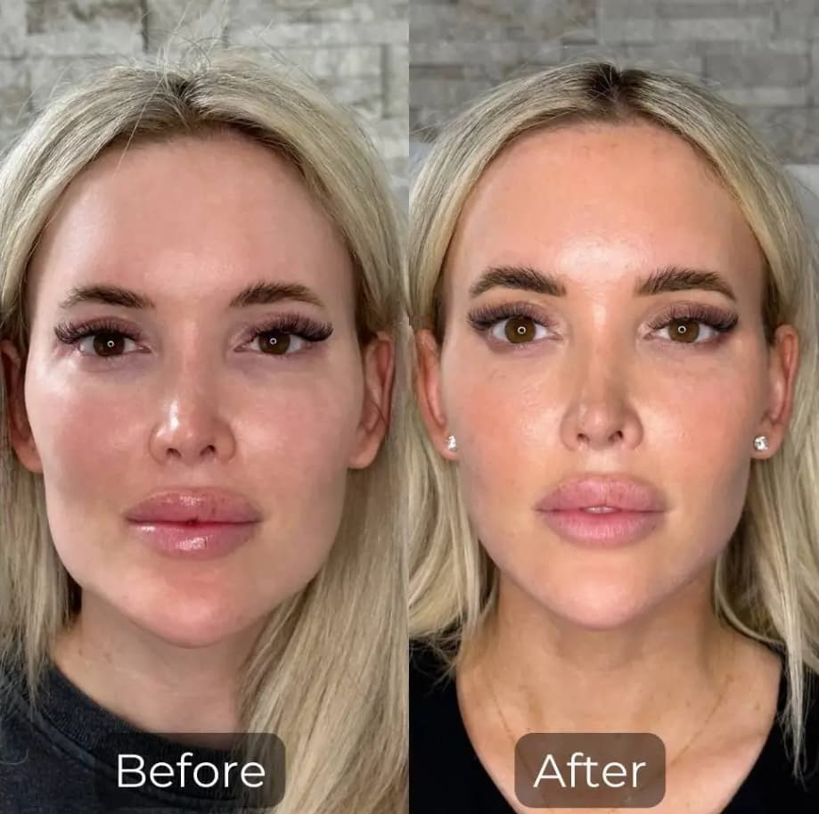 Facial Balancing Before And After facial balancing filler before after images