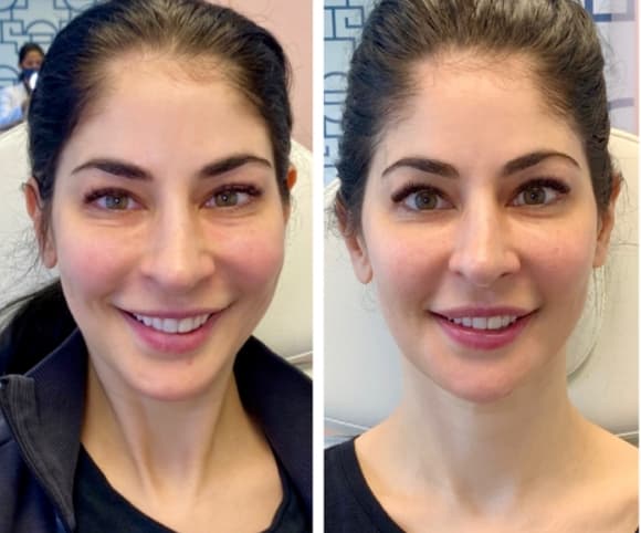 Facial Balancing Before And After facial balancing filler before and after pics