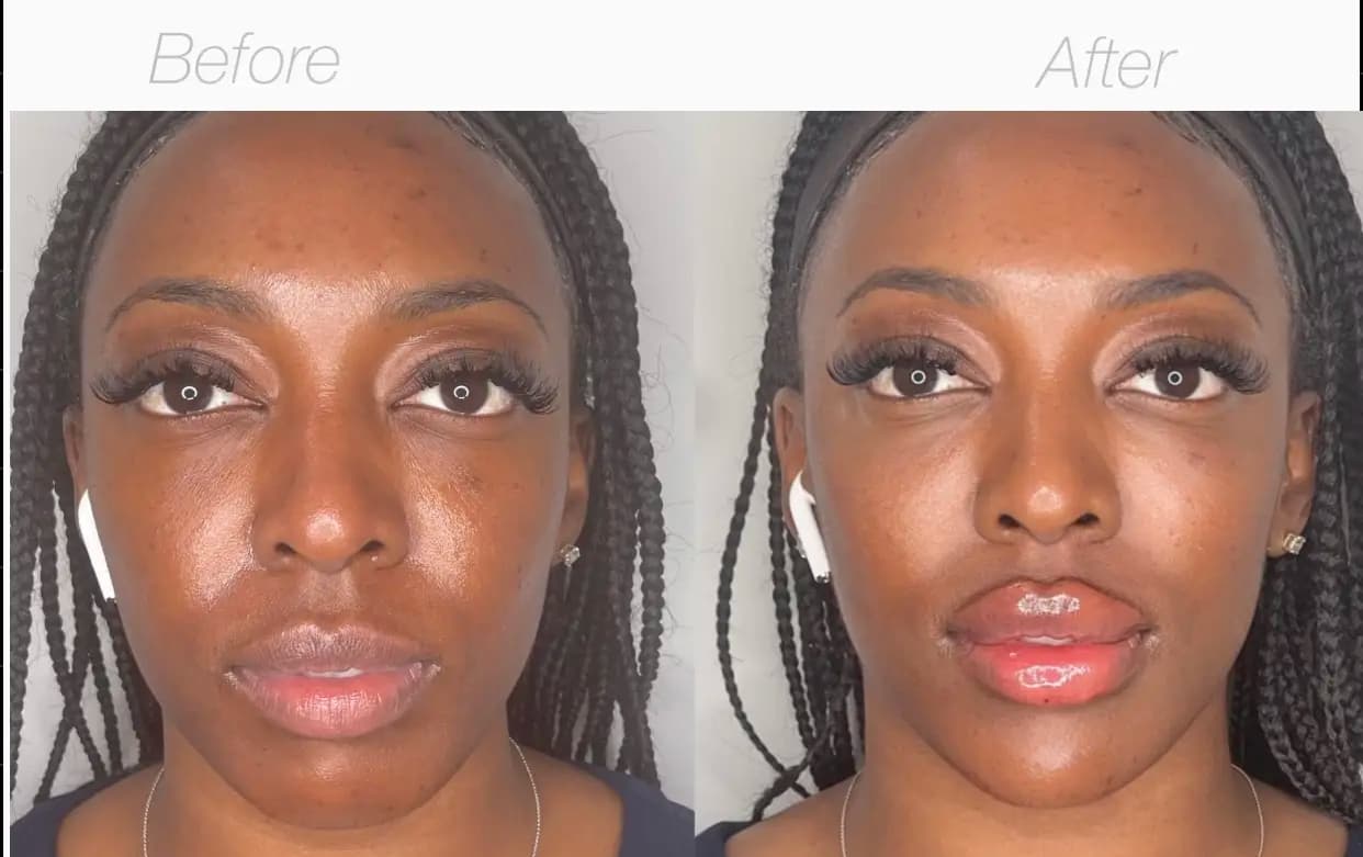 Facial Balancing Before And After facial balancing results