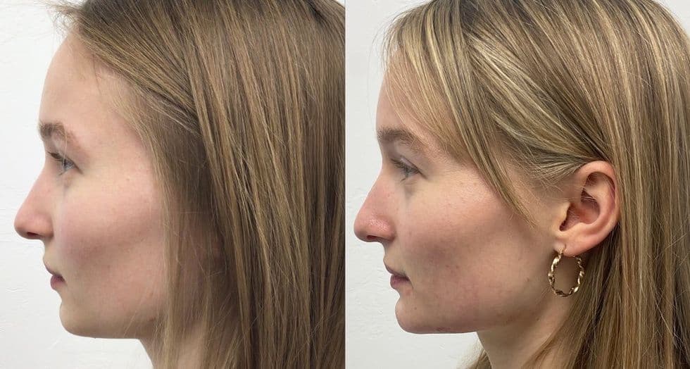 Facial Balancing Before And After facial balancing with fillers before after
