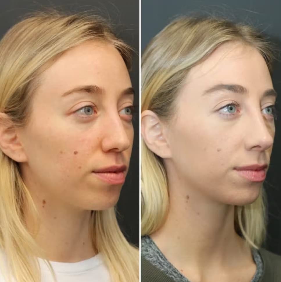 Facial Balancing Before And After facial balancing with fillers before and after