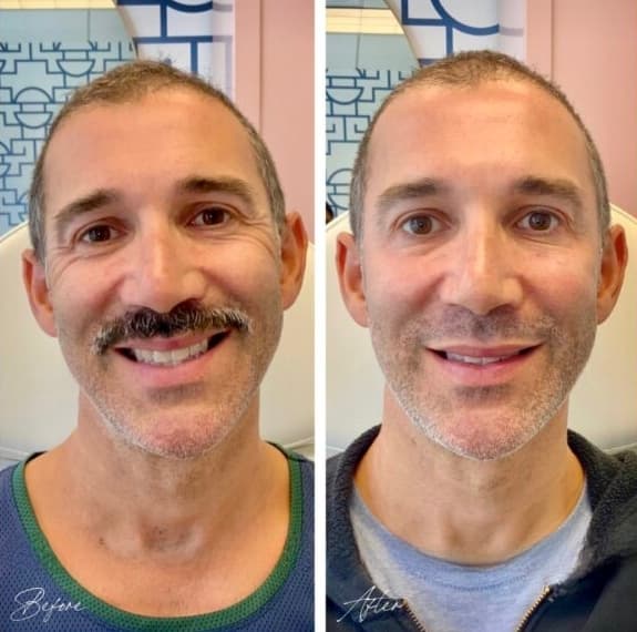 Facial Balancing Before And After facial balancing