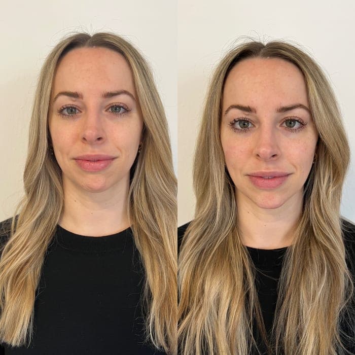 Facial Balancing Before And After full facial balancing image