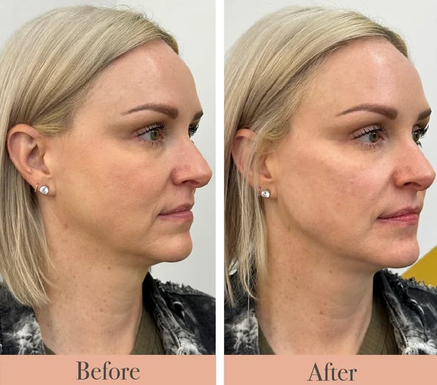 Facial Balancing Before And After full facial balancing images