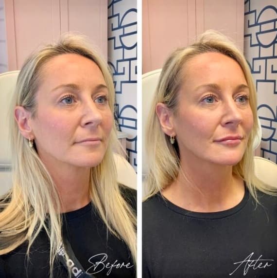 Facial Balancing Before And After full facial balancing pic