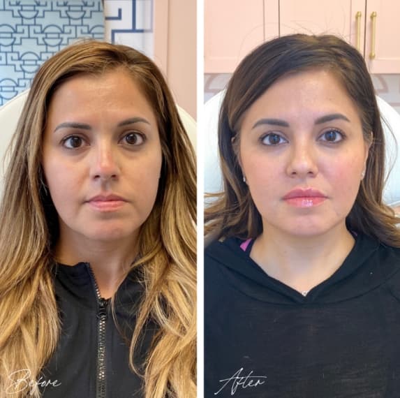 Facial Balancing Before And After full facial balancing pics