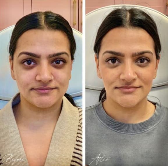 Facial Balancing Before And After full facial balancing pictures