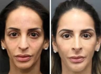 Facial Balancing Before And After full facial balancing visual