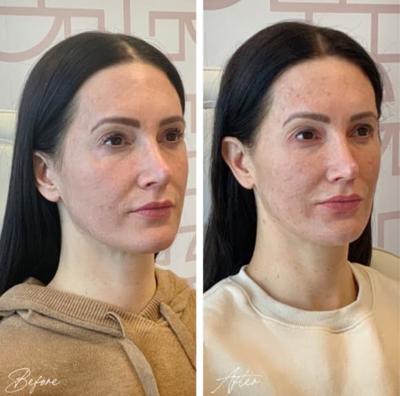 Facial Balancing Before And After full facial balancing