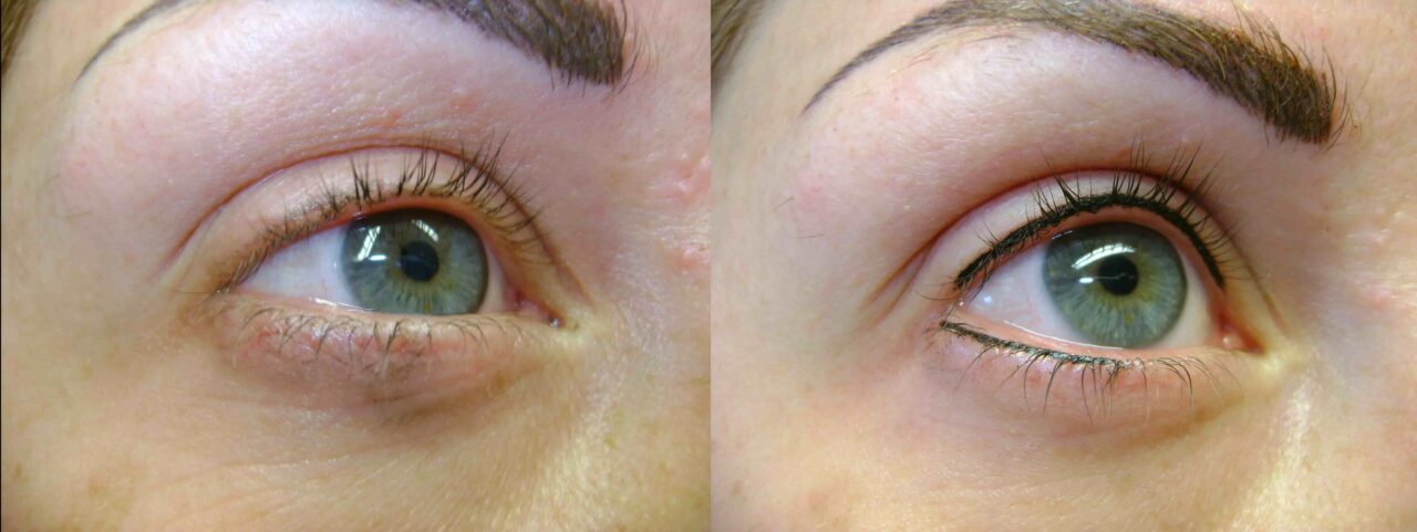 Permanent Eyeliner Before And After Pictures before and after permanent eyeliner