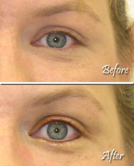 Permanent Eyeliner Before And After Pictures permanent eyeliner before after images