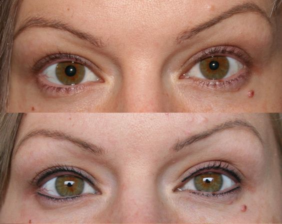 Permanent Eyeliner Before And After Pictures permanent eyeliner before after