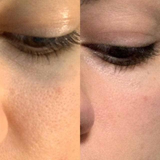 Thayers Witch Hazel Toner Before And After Results thayers witch hazel toner before and after pictures