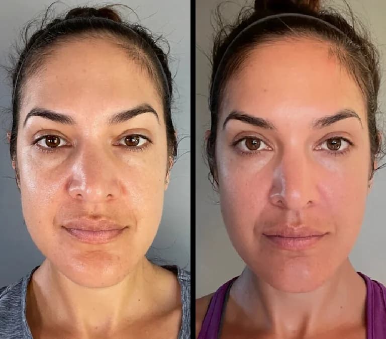 Gua Sha Before And After Photos (Jade, Quartz, and More) Gua Sha for face slimming before and after