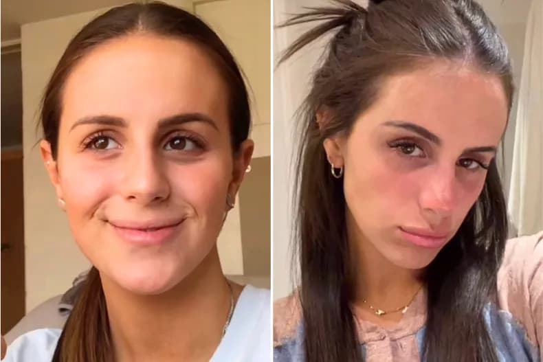 Gua Sha Before And After Photos (Jade, Quartz, and More) Gua sha before and after 1 year