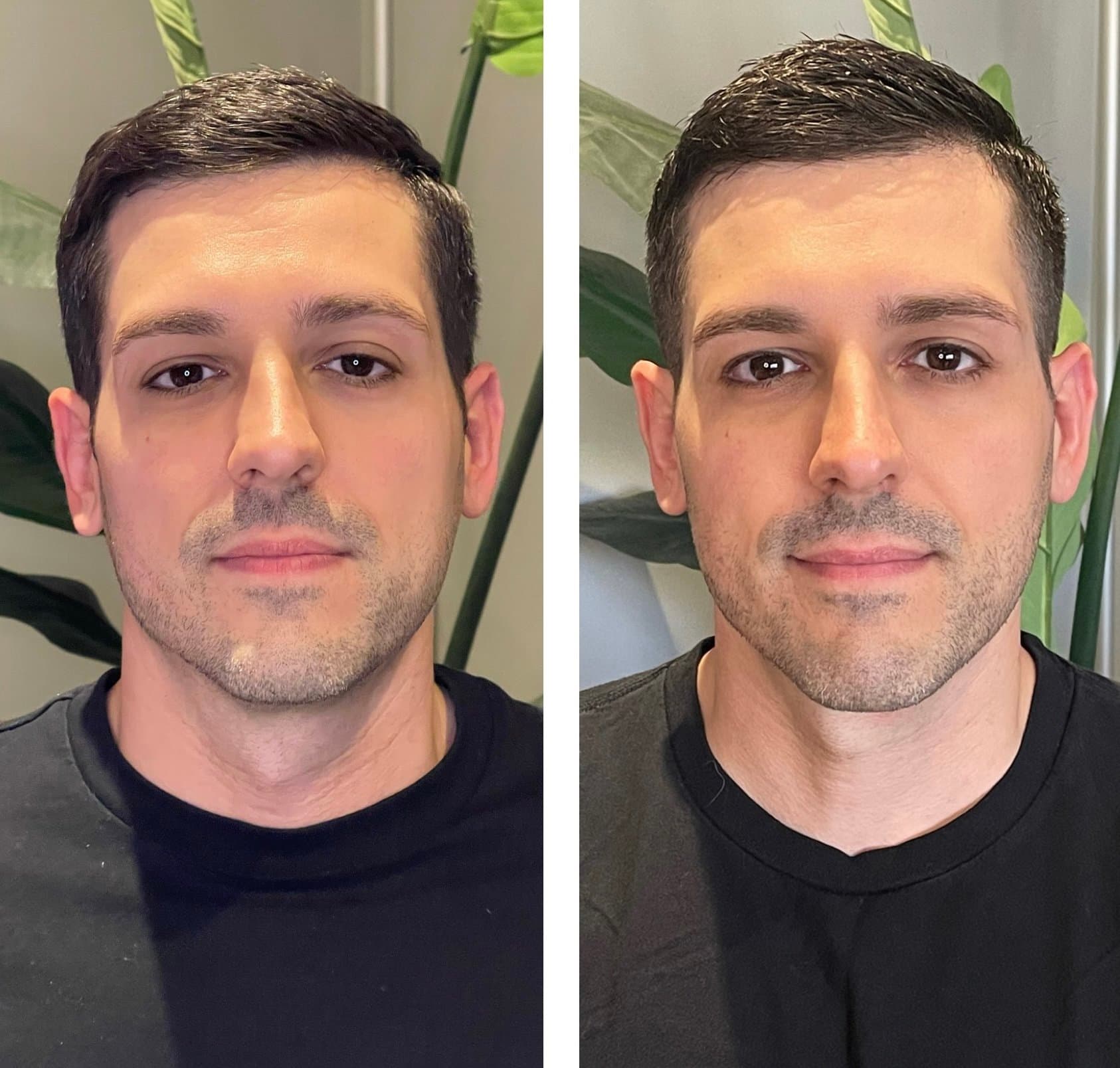 Gua Sha Before And After Photos (Jade, Quartz, and More) Gua sha before and after 30 days