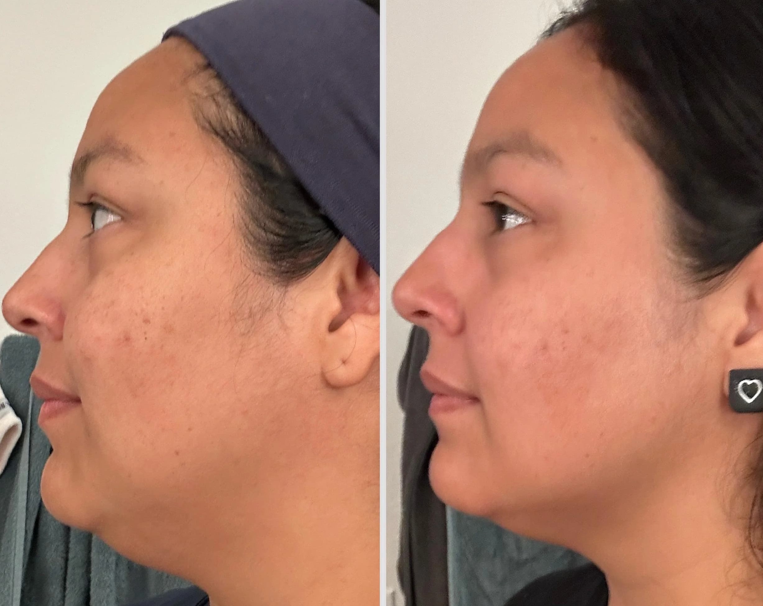 Gua Sha Before And After Photos (Jade, Quartz, and More) Gua sha before and after double chin