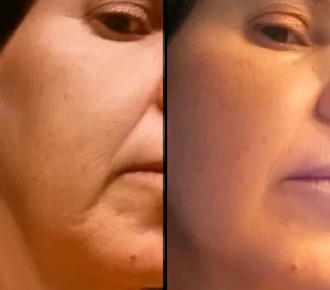 Gua Sha Before And After Photos (Jade, Quartz, and More) Gua sha before and after wrinkles