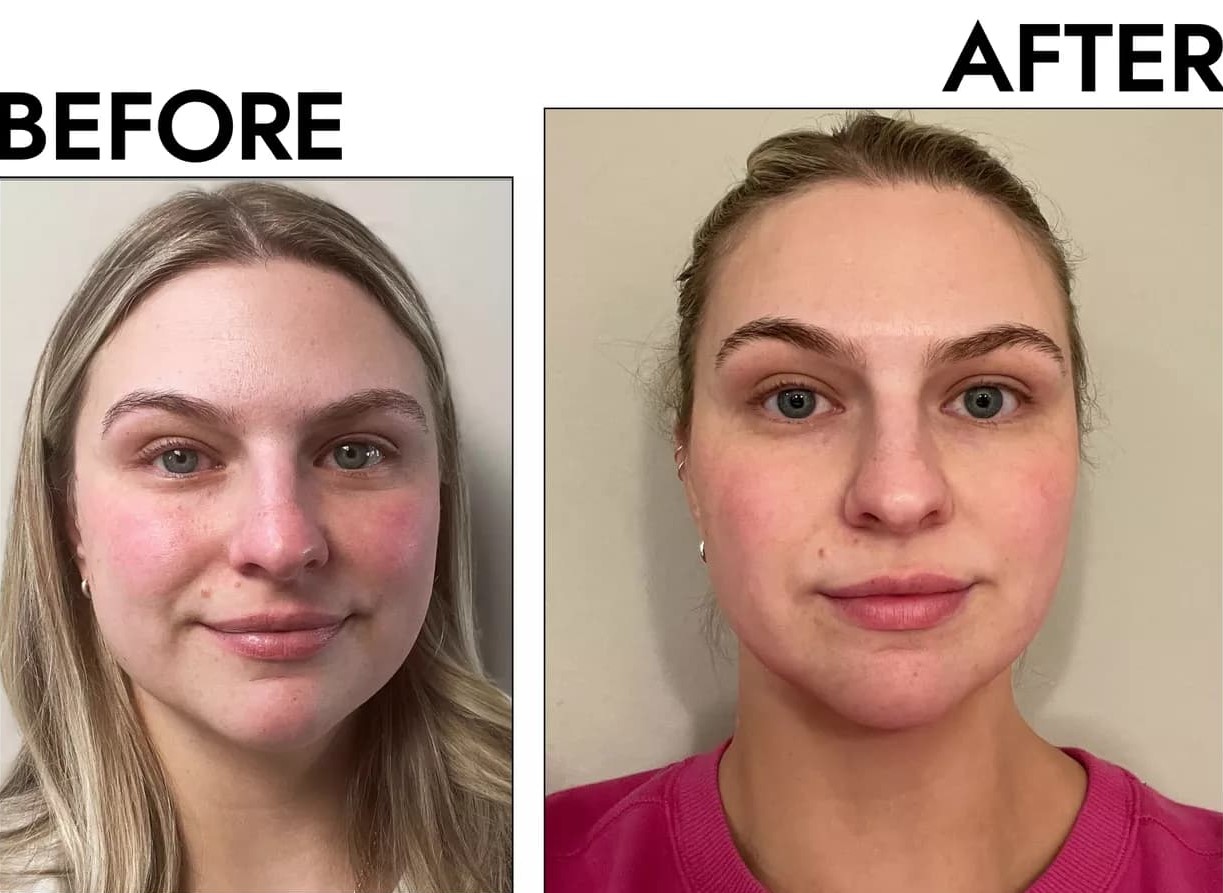 Gua Sha Before And After Photos (Jade, Quartz, and More) Jade gua sha before and after pictures