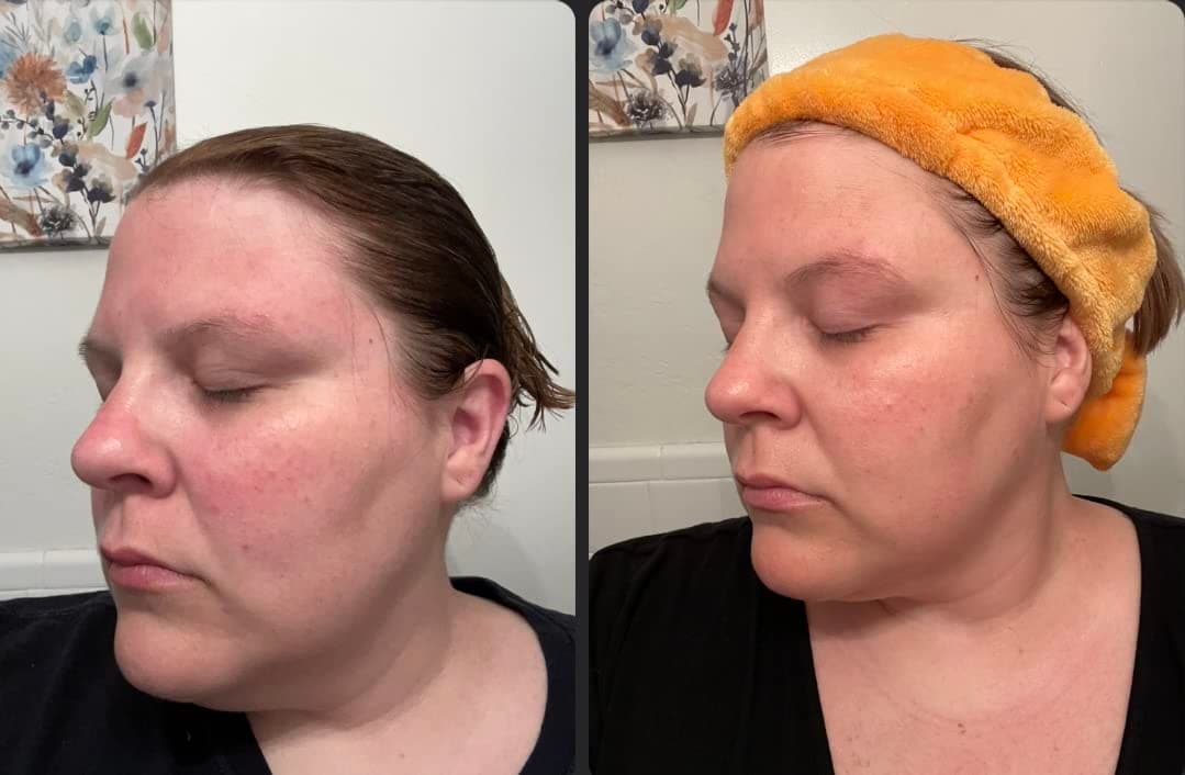 Gua Sha Before And After Photos (Jade, Quartz, and More) Rose quartz gua sha before and after face
