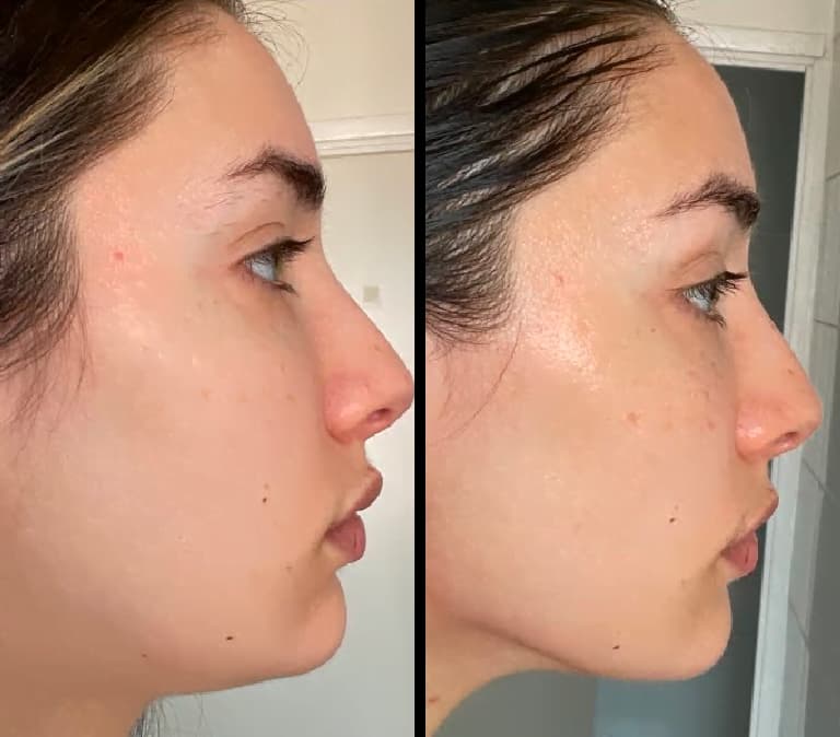 Gua Sha Before And After Photos (Jade, Quartz, and More) gua sha before and after jawline photos