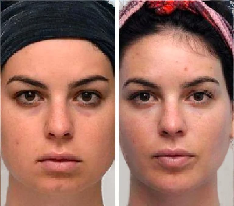 Gua Sha Before And After Photos (Jade, Quartz, and More) gua sha befre and after pictures