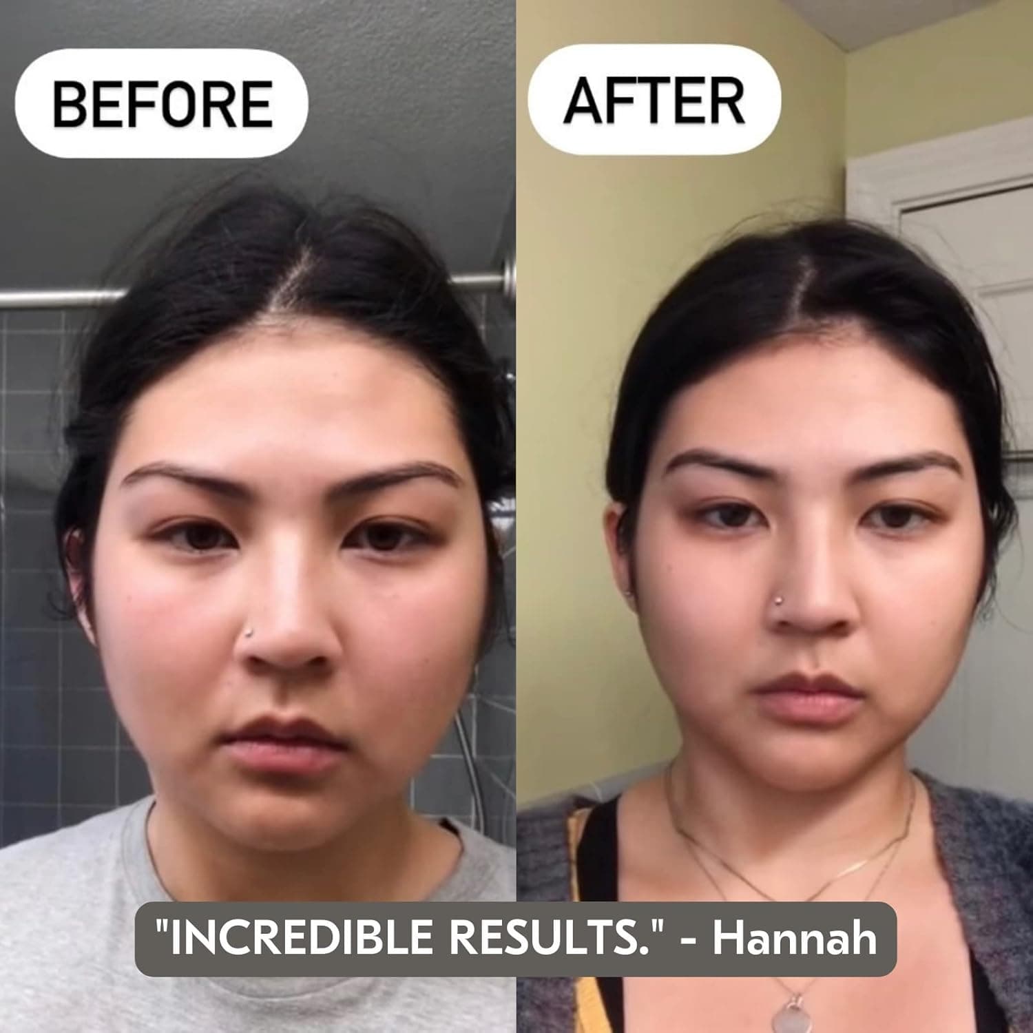Gua Sha Before And After Photos (Jade, Quartz, and More) mount lai gua sha before and after