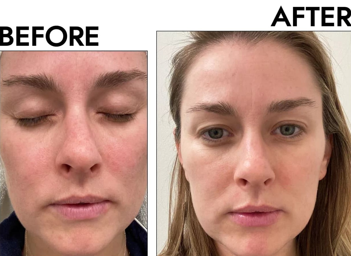 Gua Sha Before And After Photos (Jade, Quartz, and More) stainless steel gua sha Before And After face