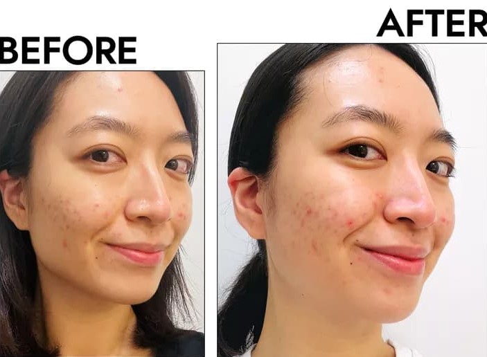 Gua Sha Before And After Photos (Jade, Quartz, and More) stainless steel gua sha before and after photos