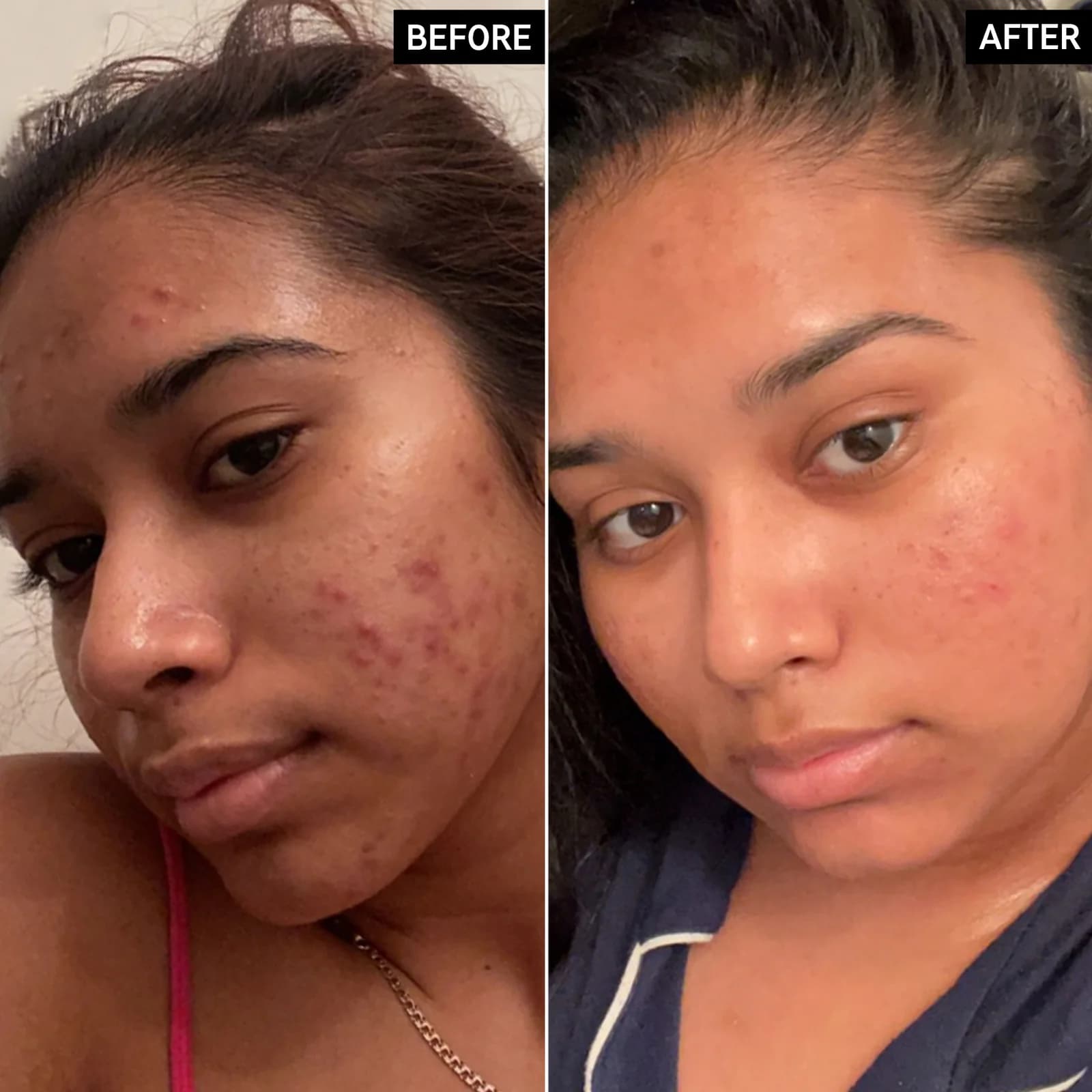 Face Before And After Vitamin C Serum Pictures Best face before and after vitamin c serum