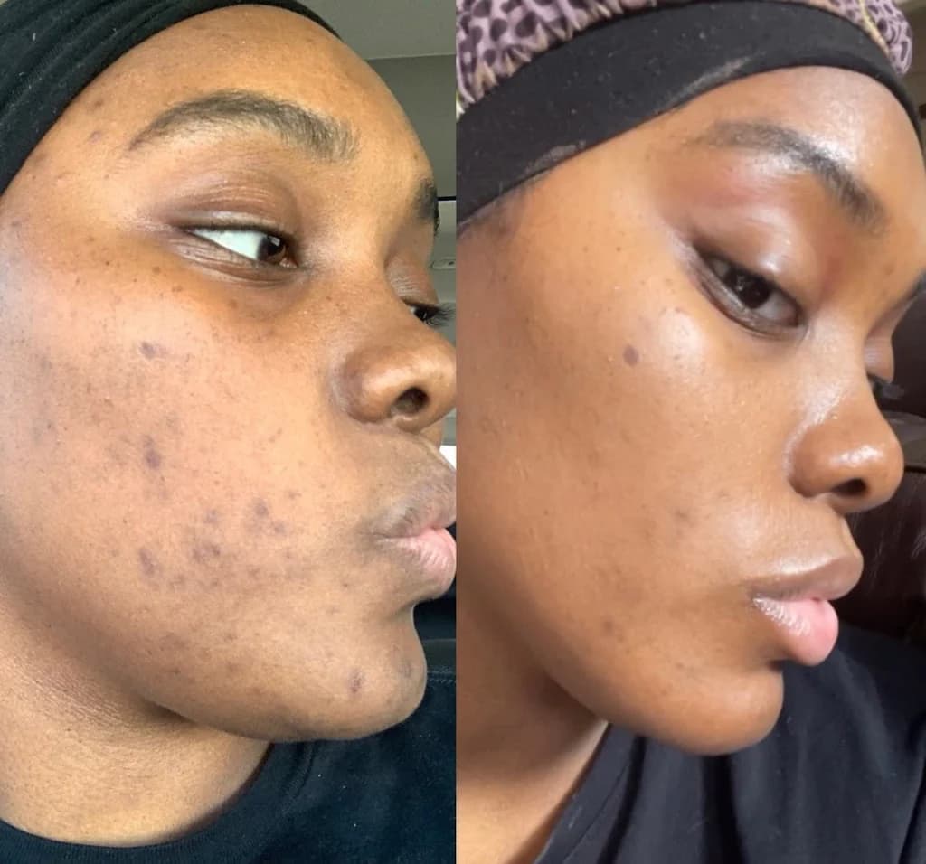 Face Before And After Vitamin C Serum Pictures Vitamin C before and after Black skin