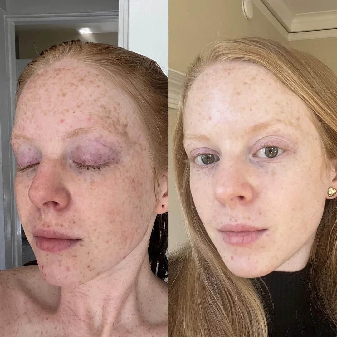 Face Before And After Vitamin C Serum Pictures Vitamin C serum benefits