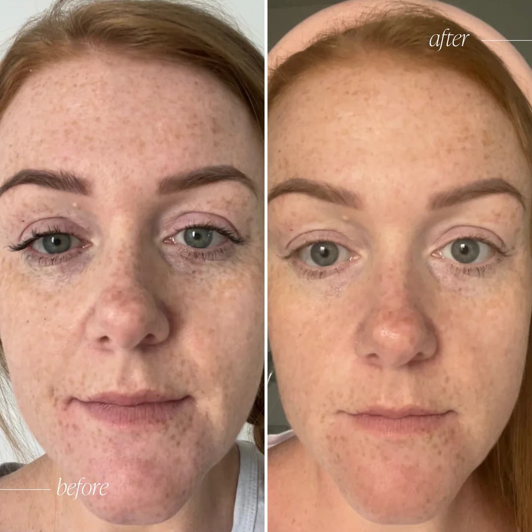 before and after vitamin c serum​