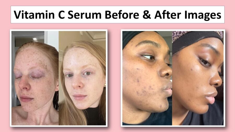 What Is Vitamin C For Face Before And After? A Simple Explanation