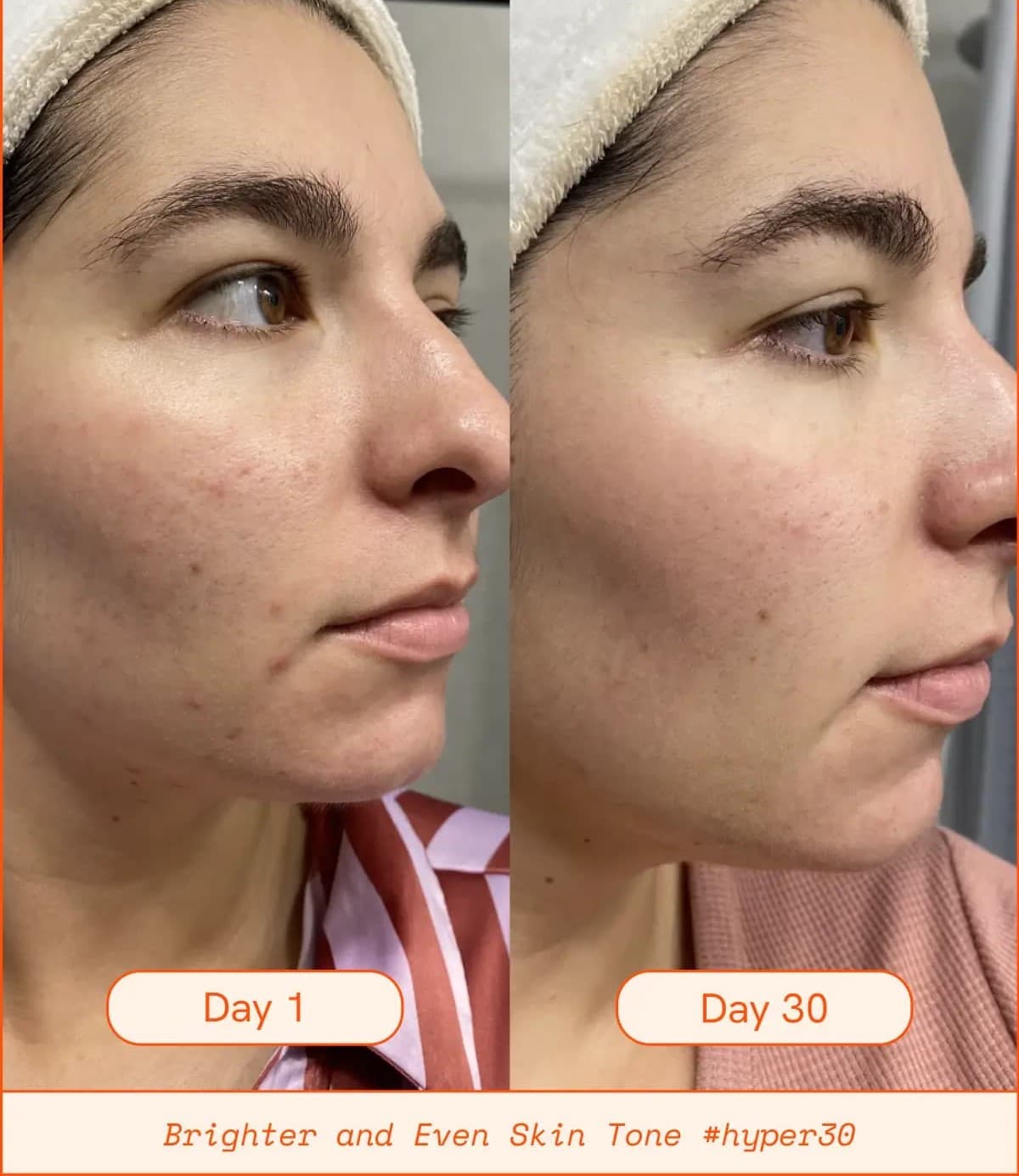 Face Before And After Vitamin C Serum Pictures vitamin c serum for face before and after pics