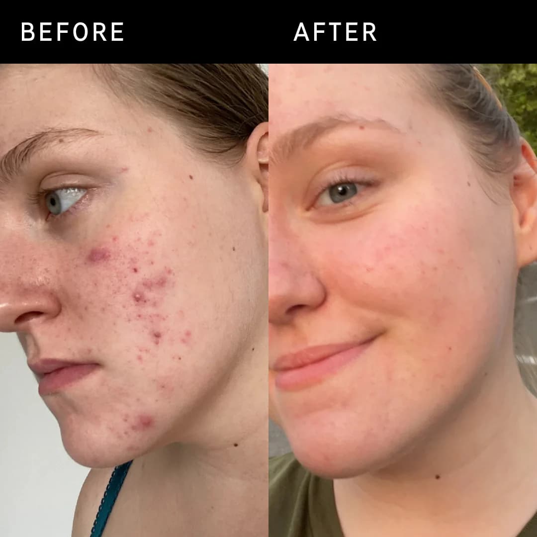 vitamin c serum on face before and after​ images