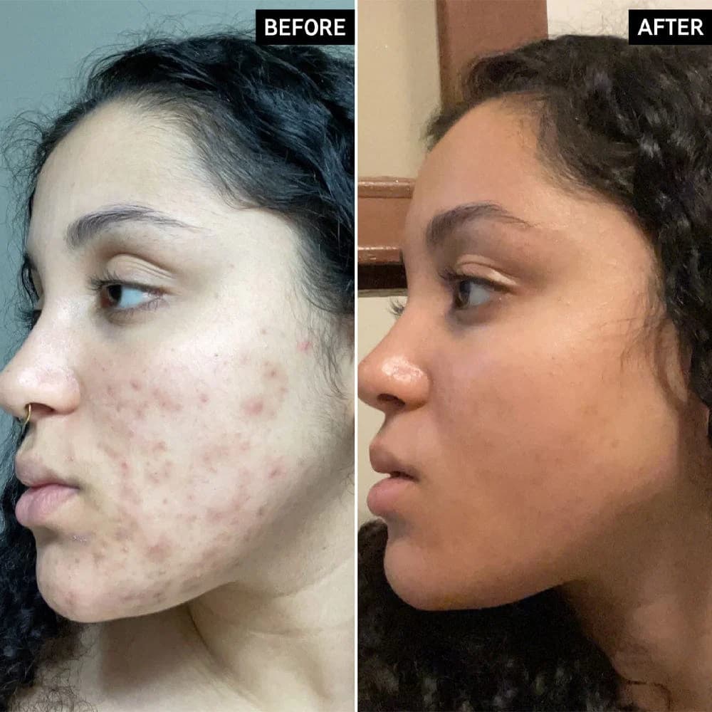 vitamin c serum on face before and after​ photos