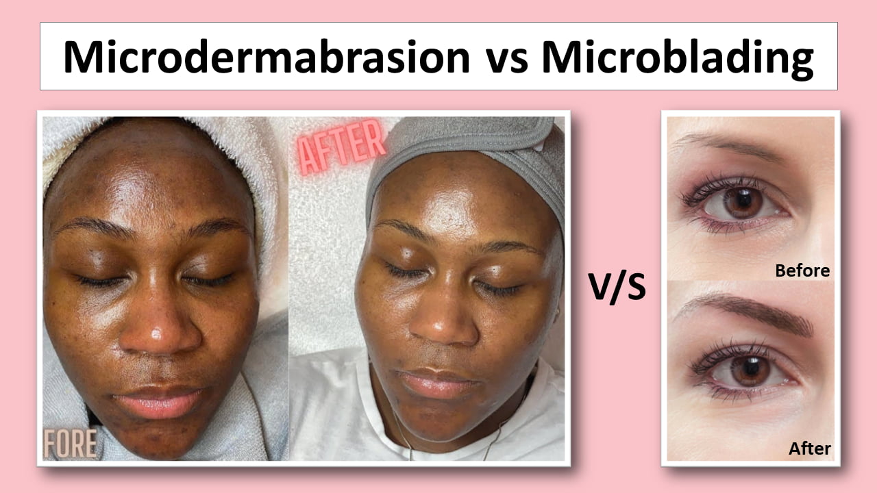 Microdermabrasion vs Microblading